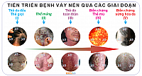 Bệnh vảy nến (Psoriasis) 