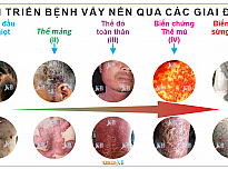 Bệnh vảy nến (Psoriasis) 