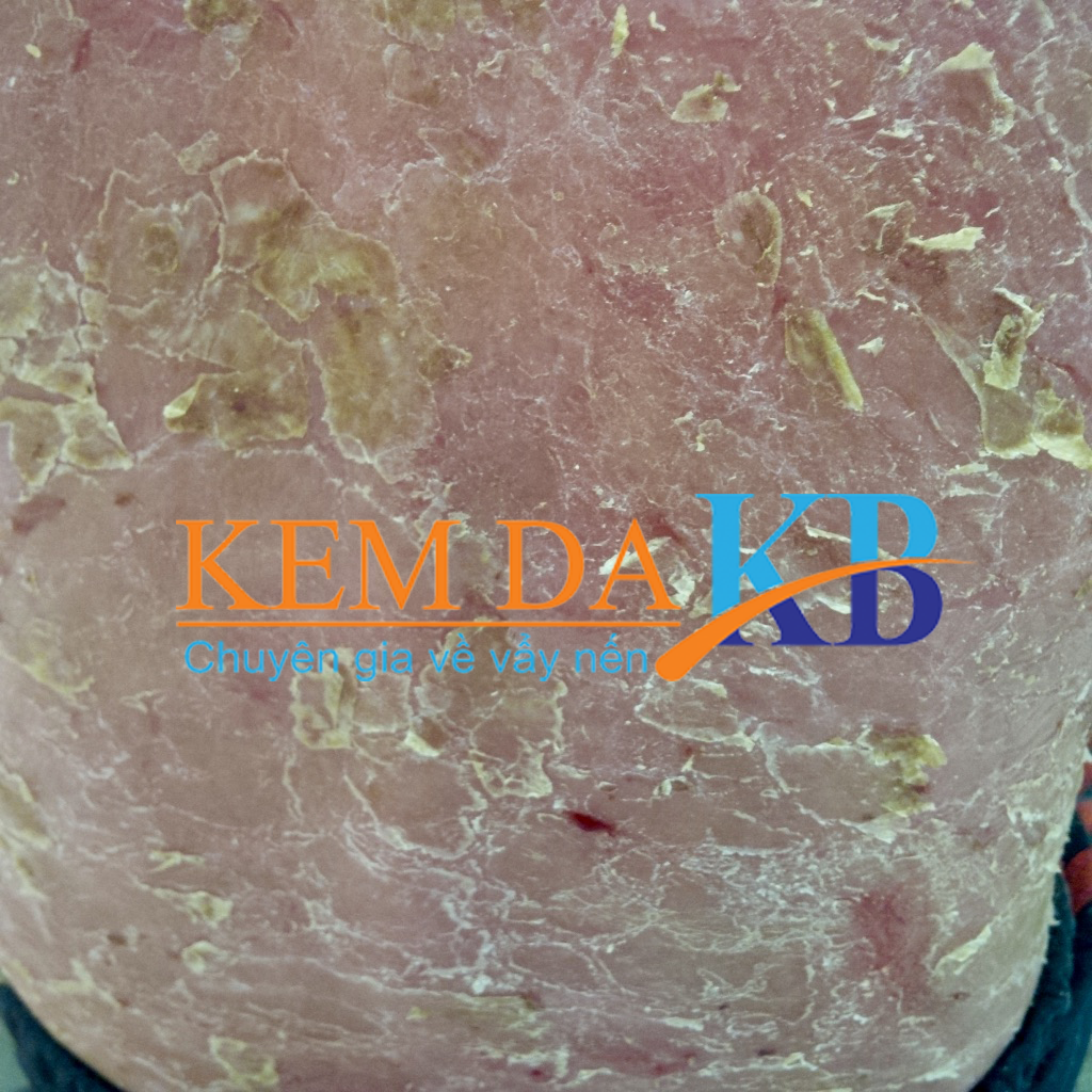 kem-da-kb-vay-nen-the-mu-01-3 vẩy nến thể mủ